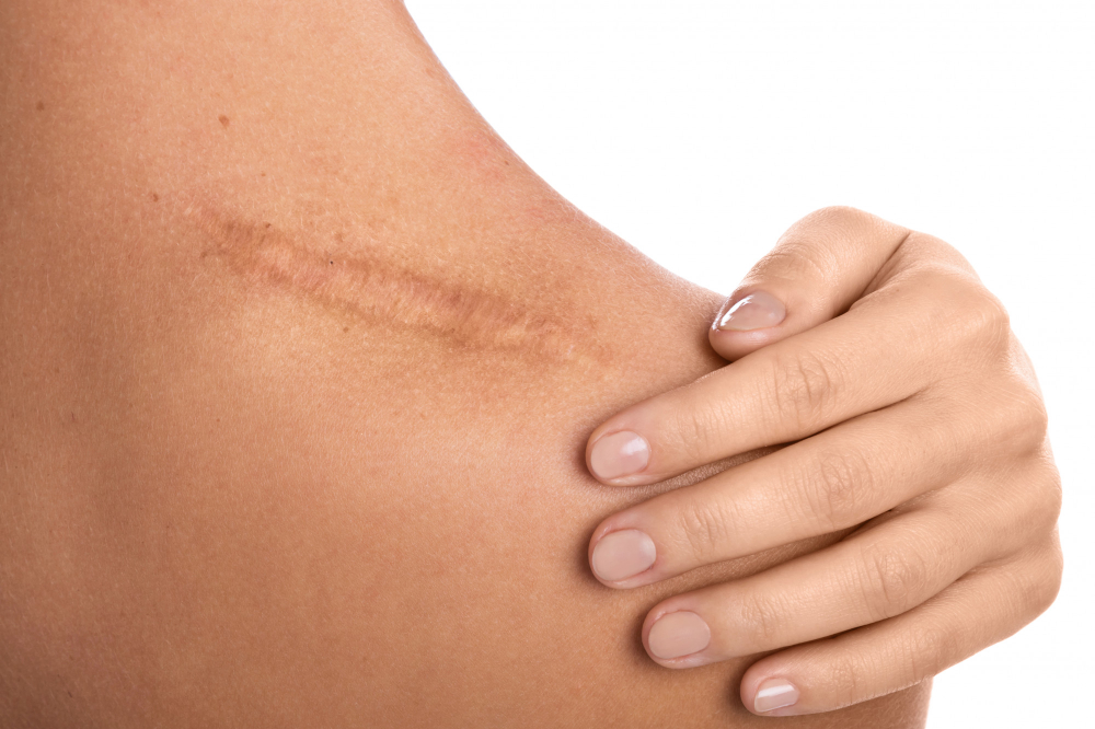 Understanding Liquid Lipo for Scars and Lipomas