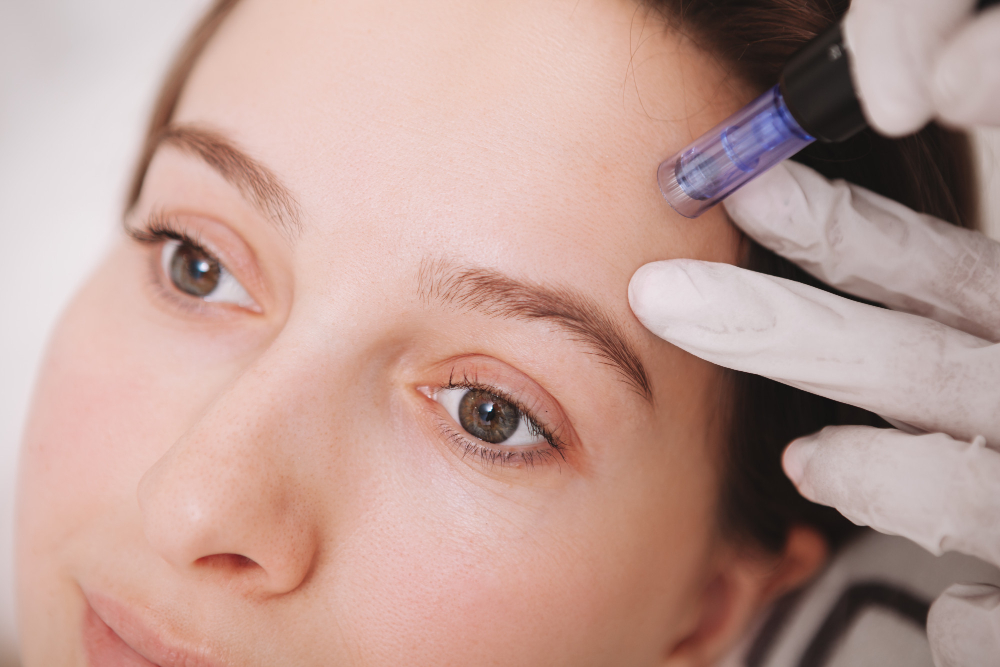 How Microneedling Can Help Fade Scars