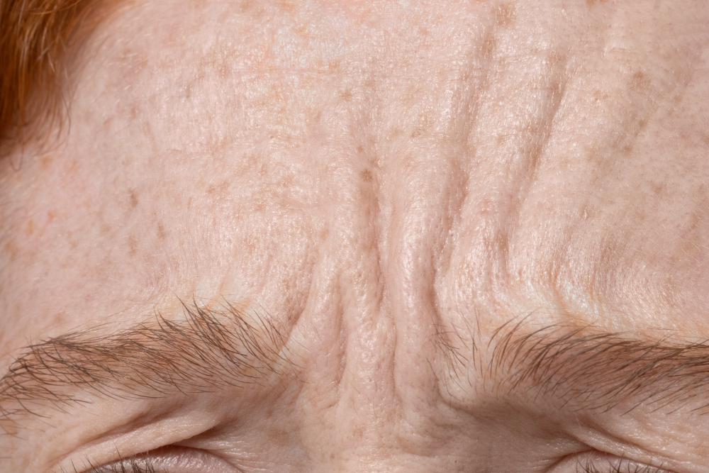 How to Get Rid of Forehead Wrinkles