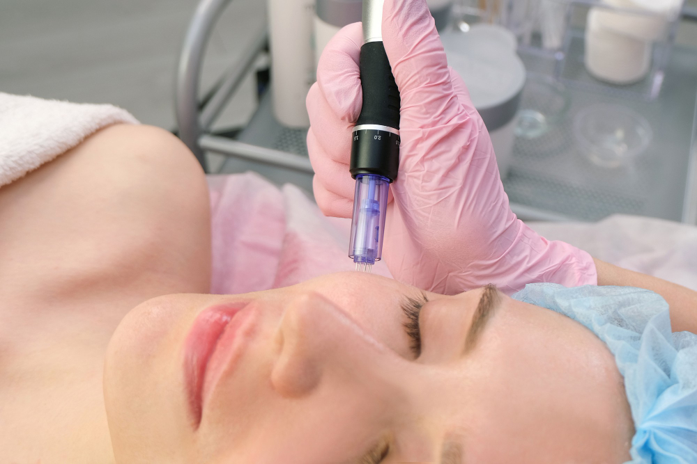 Microneedling: Myths and Facts You Need to Know