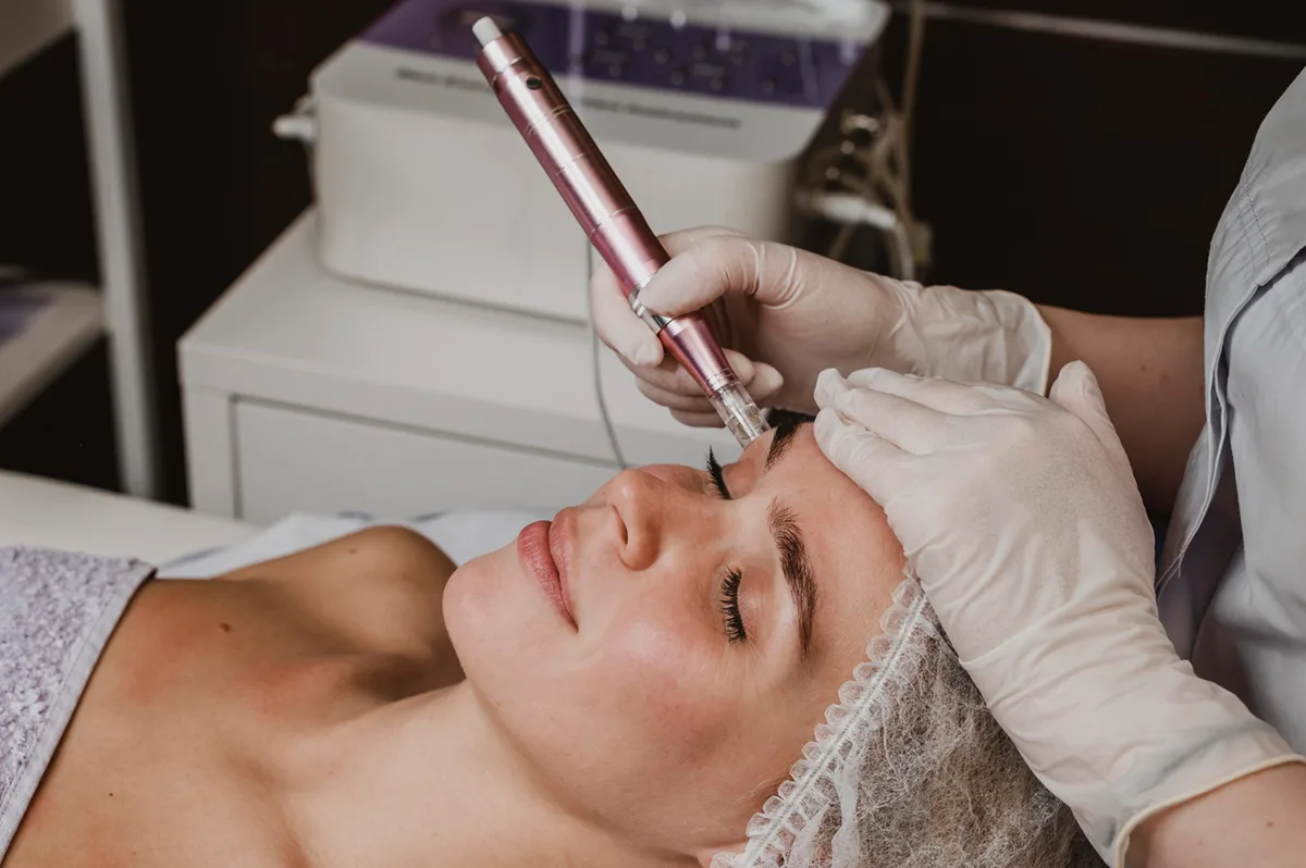 The Ultimate Guide to Microneedling Treatment Process