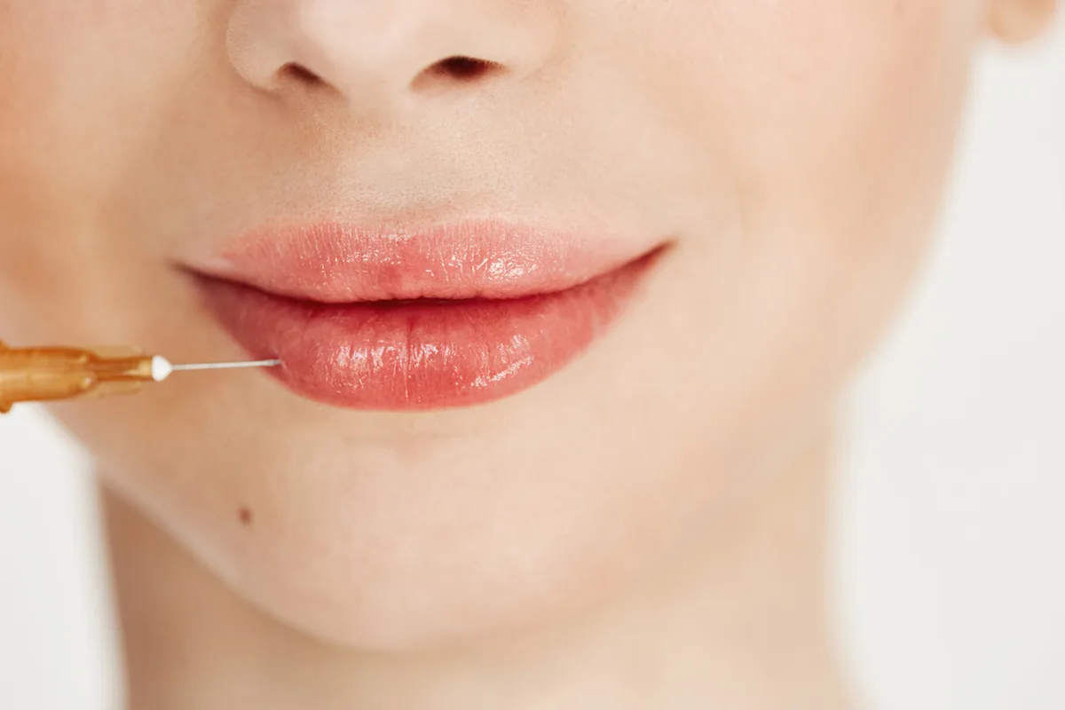 The Benefits of Getting Lip Filler
