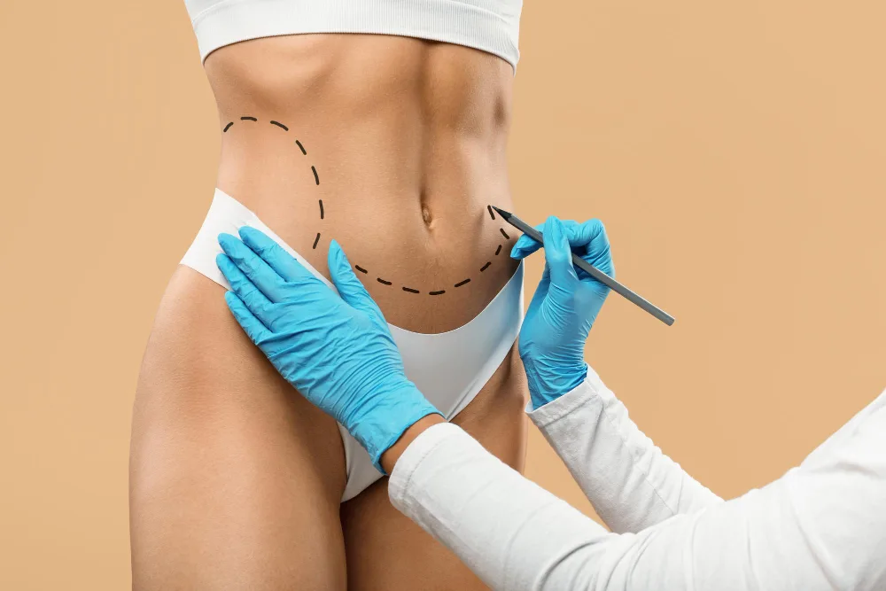 FAQs About Liquid Liposuction