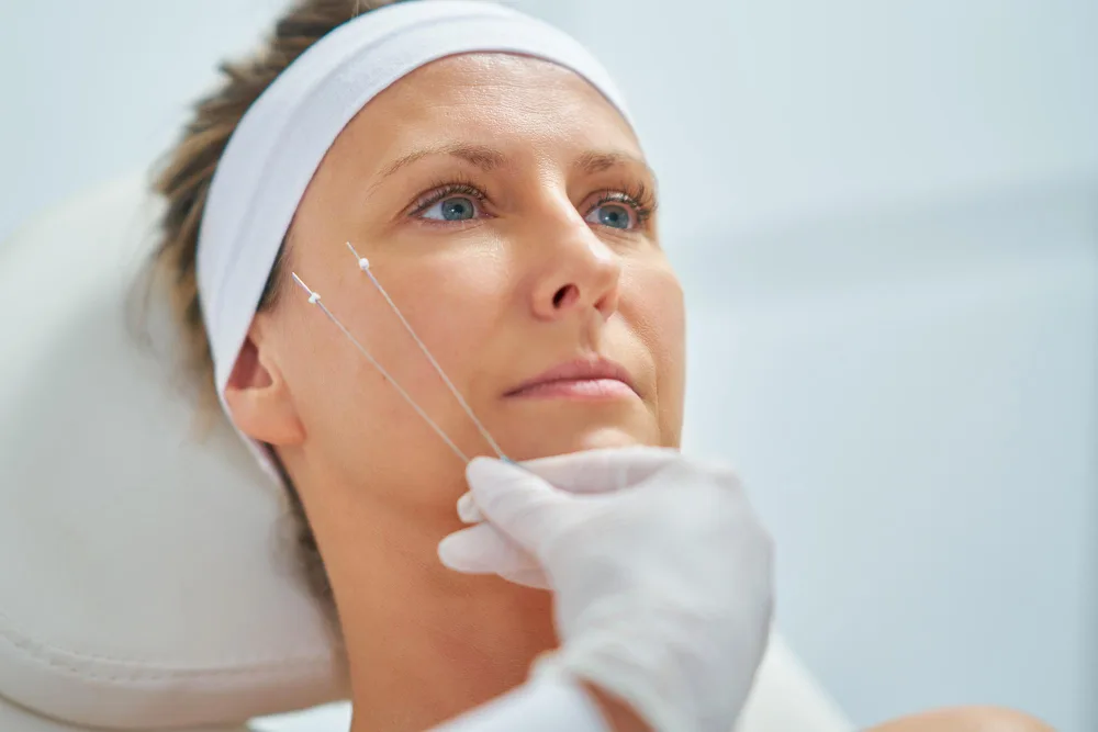 PDO Threads: Your Path to Younger-Looking Skin Without Surgery