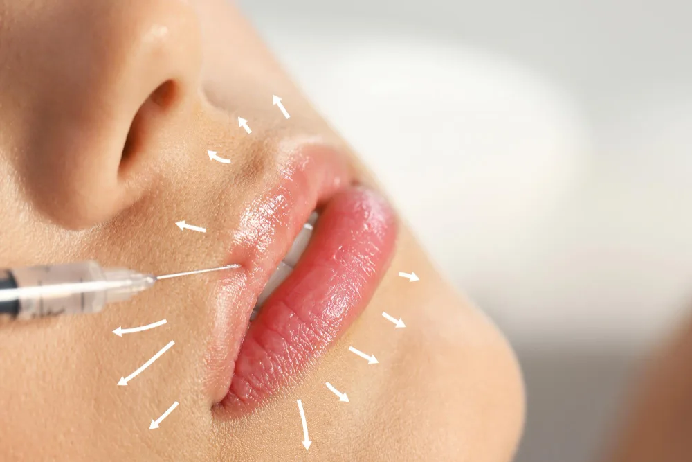 How Fillers Create Subtle Lip Enhancement