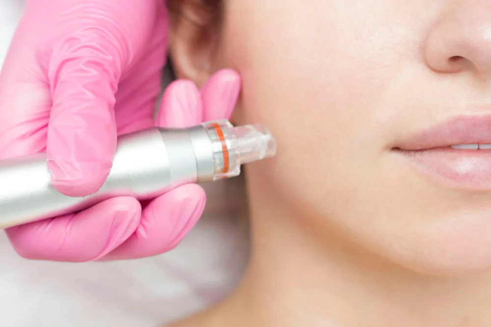 Is Microneedling Worth It? Exploring the Benefits and Risks of Microneedling