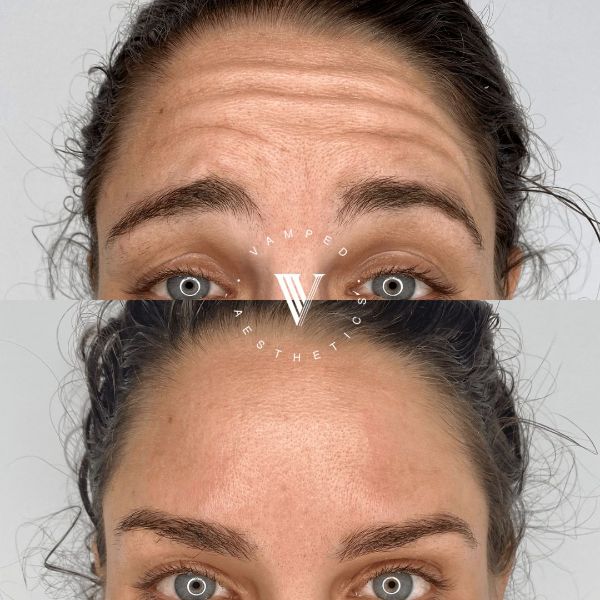 Vamped Aesthetics - Before & After Botox Treatment