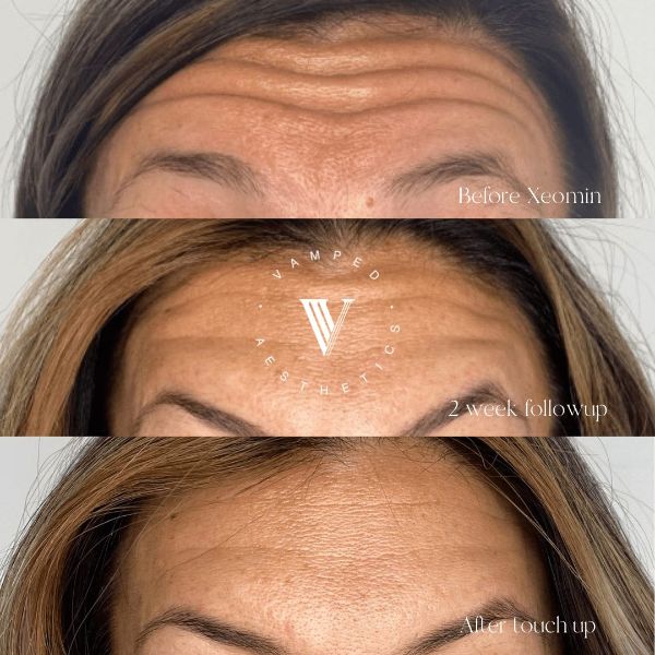 Vamped Aesthetics - Before & After Botox Treatment