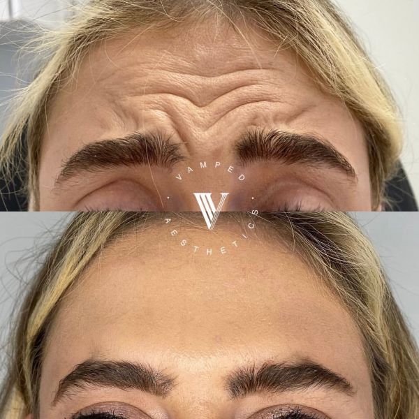 Vamped Aesthetics - Before & After Botox Treatment