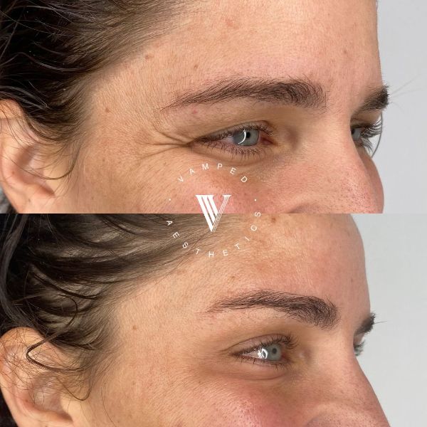 Vamped Aesthetics - Before & After Botox Treatment