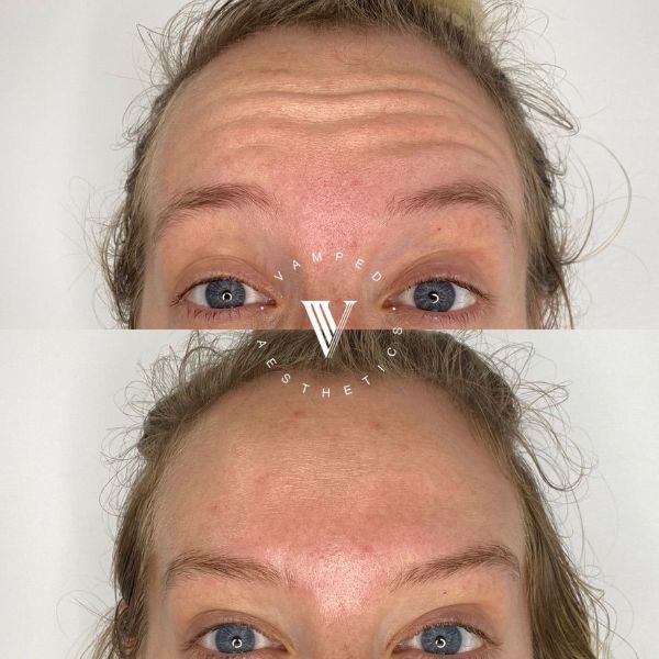 Vamped Aesthetics - Before & After Botox Treatment