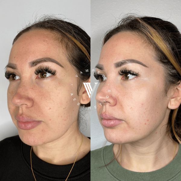 Vamped Aesthetics - Before & After Chemical Peel