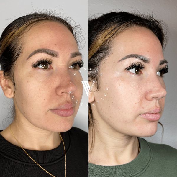 Vamped Aesthetics - Before & After Chemical Peel