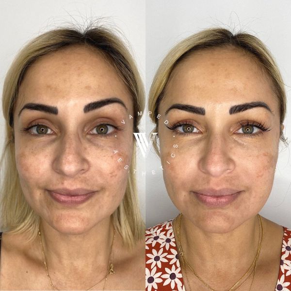 Vamped Aesthetics - Before & After Chemical Peel