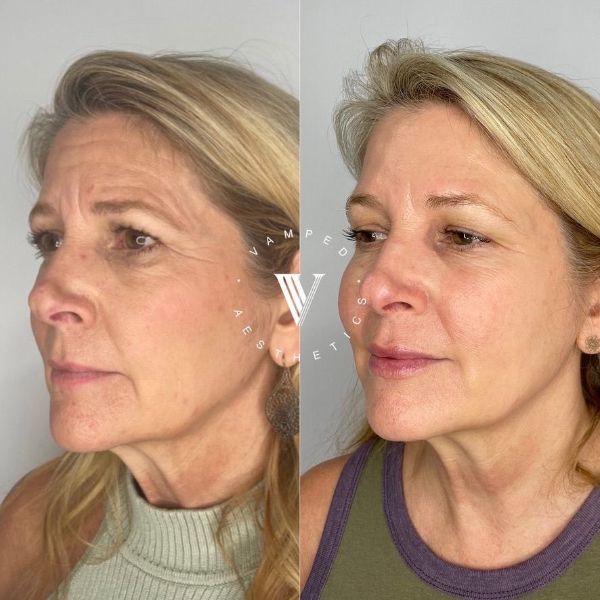 Vamped Aesthetics - Before & After Filler Treatment