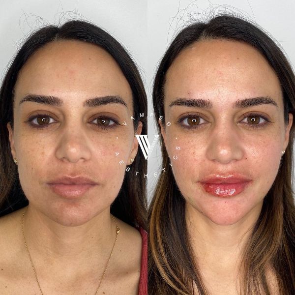 Vamped Aesthetics - Before & After Filler Treatment