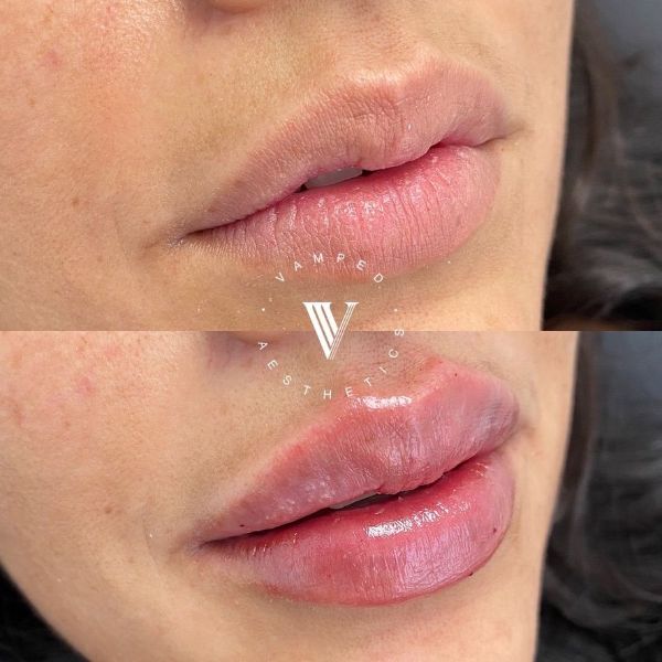 Vamped Aesthetics - Before & After Filler Treatment