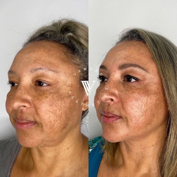 Vamped Aesthetics - Before & After Filler Treatment