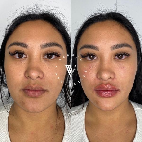 Vamped Aesthetics - Before & After Filler Treatment