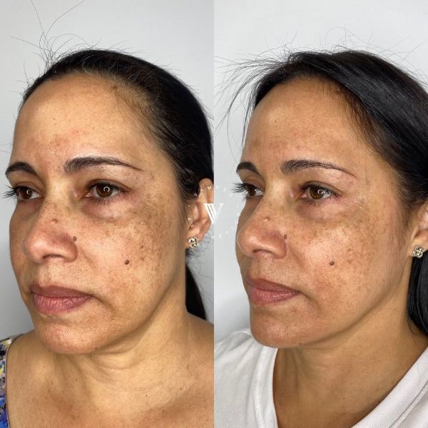 Vamped Aesthetics - Before & After Filler Treatment