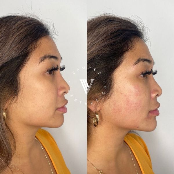 Vamped Aesthetics - Before & After Filler Treatment