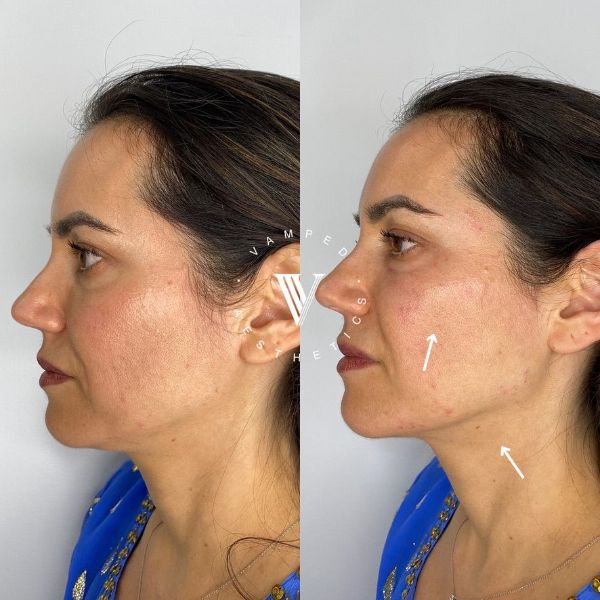 Vamped Aesthetics - Before & After Filler Treatment