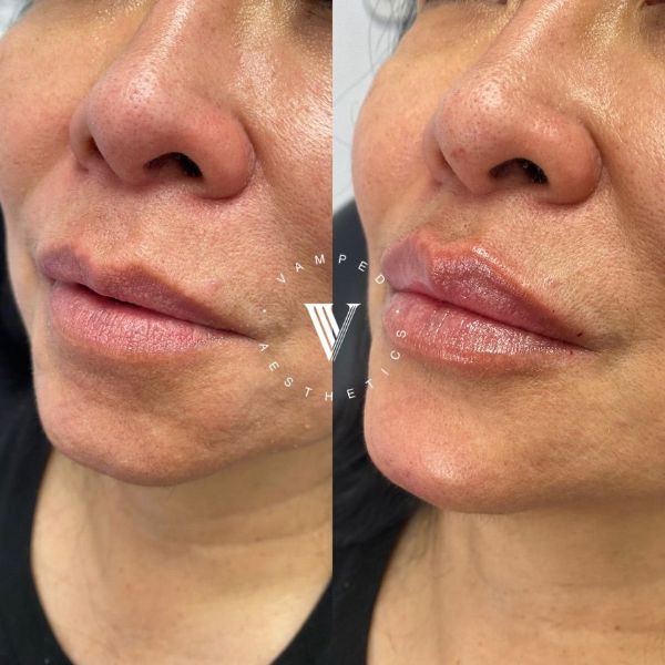 Vamped Aesthetics - Before & After Filler Treatment