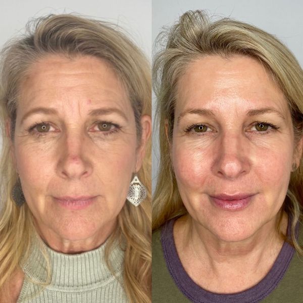 Vamped Aesthetics - Before & After Filler Treatment