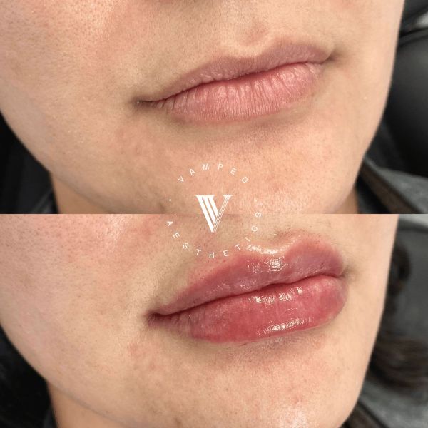 Vamped Aesthetics - Before & After Filler Treatment