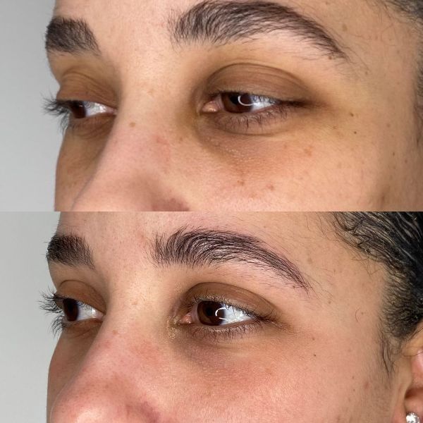 Vamped Aesthetics - Before & After Filler Treatment