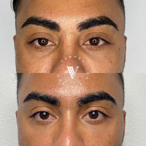 Vamped Aesthetics - Before & After Filler Treatment