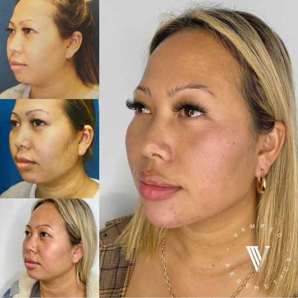 Vamped Aesthetics - Before & After Filler Treatment