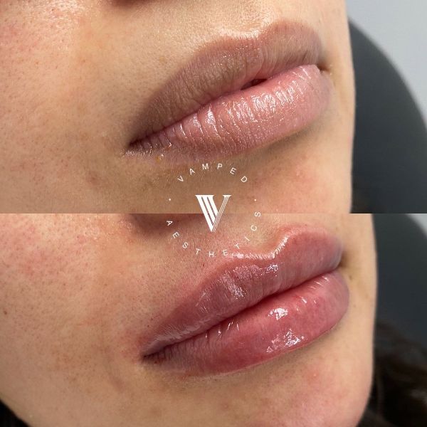 Vamped Aesthetics - Before & After Filler Treatment