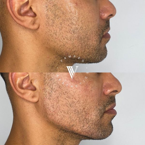 Vamped Aesthetics - Before & After Filler Treatment