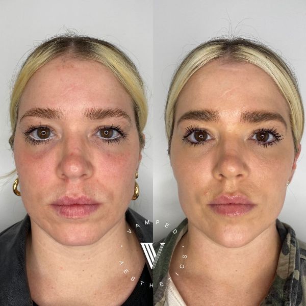 Vamped Aesthetics - Before & After Filler Treatment