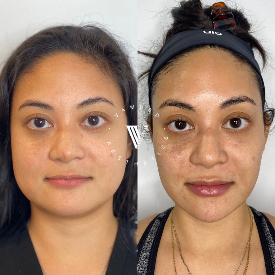 Before & After Dermal Fillers