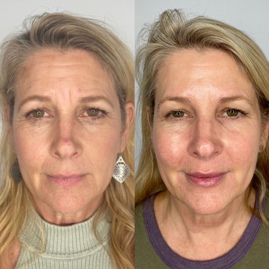 Before & After Dermal Fillers