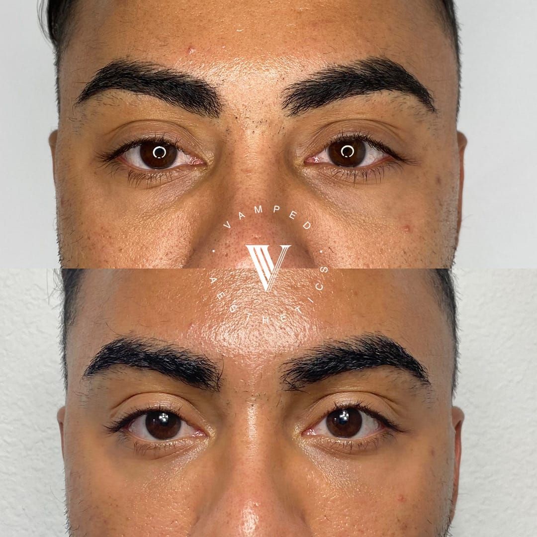 Before & After Dermal Fillers