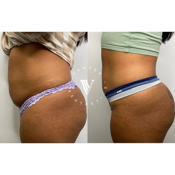 Vamped Aesthetics - Before & After Liquid Lipo