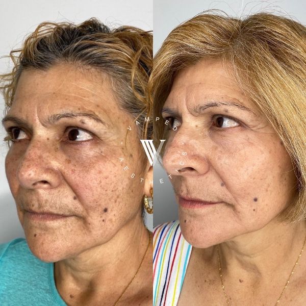 Vamped Aesthetics - Before & After Microneedling