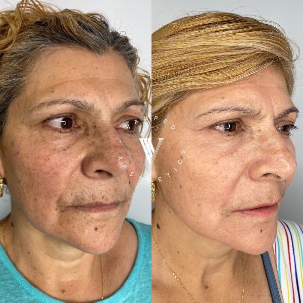 Vamped Aesthetics - Before & After Microneedling