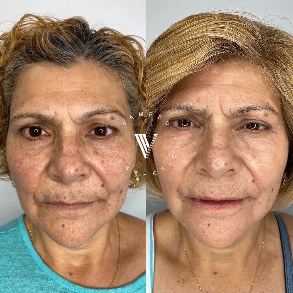 Vamped Aesthetics - Before & After Microneedling