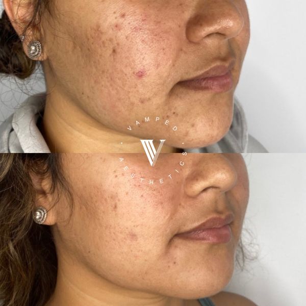 Vamped Aesthetics - Before & After Microneedling