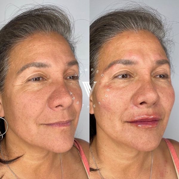 Vamped Aesthetics - Before & After Radiesse Treatment