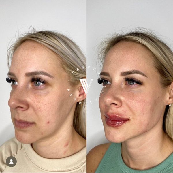 Vamped Aesthetics - Before & After Radiesse Treatment