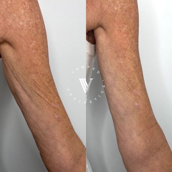 Vamped Aesthetics - Before & After Radiesse Treatment