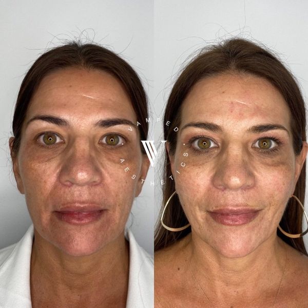 Vamped Aesthetics - Before & After Radiesse Treatment