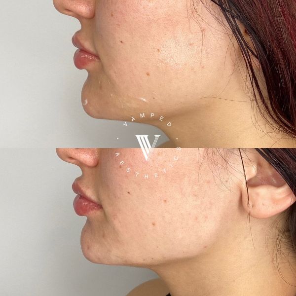 Vamped Aesthetics - Before & After Radiesse Treatment