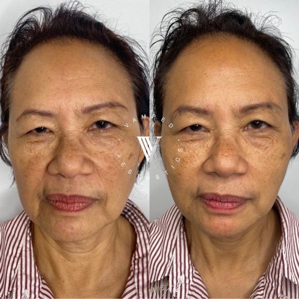 Vamped Aesthetics - Before & After Radiesse Treatment