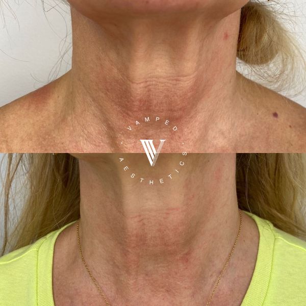 Vamped Aesthetics - Before & After Radiesse Treatment